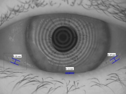 Figure 2 Tear meniscus height (TMH) measurements as generated by the Keratograph 5M. The final TMH is calculated from the average of the TMH measurements at the left, right and center of each eyelid. The final TMH in this eye is 0.36 mm.