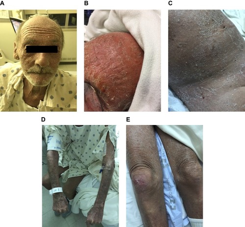 Figure 1 Patient’s appearance upon admission with diffuse exfoliative maculopapular rash shown on the (A) head, (B) forehead, (C) abdomen, (D) arms and (E) legs.
