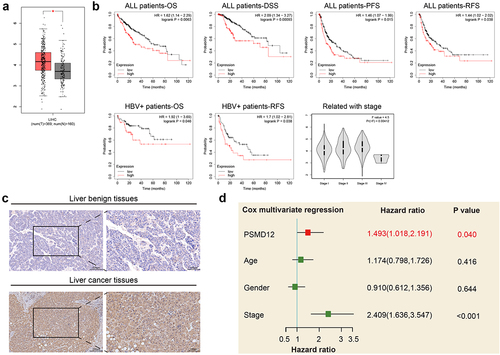 Figure 1. PSMD12 was highly expressed in liver cancer tissues and indicated a worse prognosis. (a) PSMD12 was highly expressed in liver cancer tissues (N = 369) compared with normal liver tissues (N = 160) according to analysis of data from TCGA database. (b) Kaplan–Meier analysis of all liver cancer patients and liver cancer patients infected with HBV according to PSMD12 expression from the TCGA database indicated that high expression of PSMD in liver cancer indicated a worse prognosis. Meanwhile, the expression of PSMD12 was positively associated with the tumor stage of liver cancer. (c) Expression of PSMD12 in liver cancer tissues and normal tissues by immunohistochemistry (magnification ×200) (d) According to multivariate Cox regression analysis, PSMD12 was independently associated with poor prognosis after adjustment for age, sex and tumor stage.