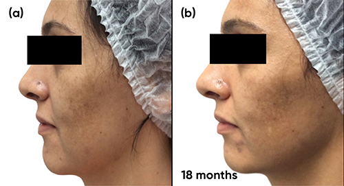 Figure 8 Case study 3 improvement left side, baseline to 18 months (a) Baseline following 9 months with spironolactone 50mg twice a day plus AZA 15% gel twice a day (b) 9 months with spironolactone 25mg twice a day plus AZA 15% gel twice a day.