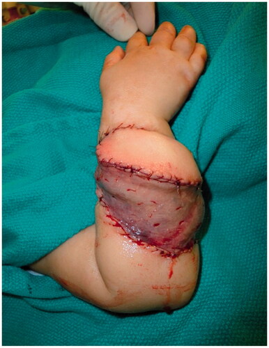 Figure 6. Intra-operative photograph of the final inset of the latissimus dorsi flap with a skin paddle and split thickness skin graft.
