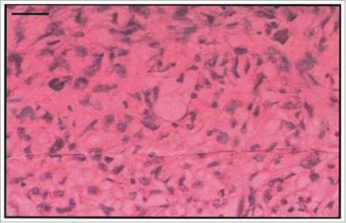 Figure 2. Hematoxylin and eosin staining of a tumor section(scale bar 100μm).