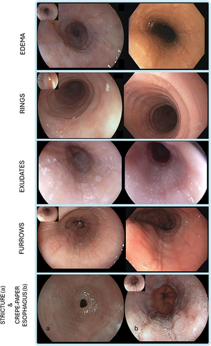 Figure 1 Examples of the different components of the EoE endoscopic reference score. Edema refers to the loss of normal vascular markings on the esophageal surface. Rings are circumferential ridges that are not modified by esophageal peristalsis. Exudates are white spots on the esophageal mucosa. Furrows are longitudinal red lines with variable depth. Stricture is a discrete luminal narrowing that may be non-negotiable with the endoscope (bottom left a). Crepe-paper esophagus refers to the frail and whitish appearance of the esophageal mucosa, similar to that of crepe-paper (bottom right b).