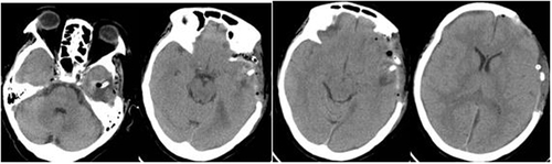 Figure 5 The CT of the second day after operation. Diagnosis (TNGS & GD) result of the patient.
