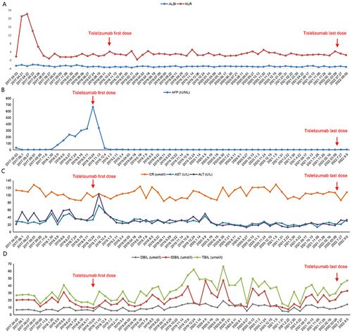 Figure 2 Evolution in time of the albumin-bilirubin (ALBI) score and neutrophil-to-lymphocyte ratio (NLR) (A), α-fetoprotein (AFP) levels (B), aspartate aminotransferase (AST), creatinine (CR), and alanine aminotransferase (ALT) (C), direct bilirubin (DBIL), indirect bilirubin (IDBIL), and total bilirubin (TBIL) (D).