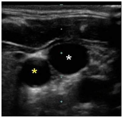 Figure 7 Ultrasound image of right carotid artery (yellow star) and right internal jugular vein (white star).