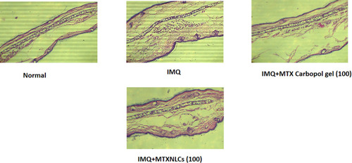 Figure 8 Effect of MTXNLCs on histopathological alterations in IMQ-induced psoriasis in mice.
