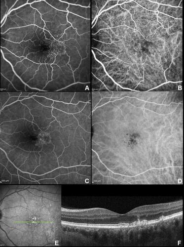 Figure 2 Fluorescein angiography (FA) and indocyanine green angiography (ICGA). Arteriovenous phase (0:43 seconds) showing the typical “stars-in-the-sky” appearance at both FA (A) and ICGA (B); The hyperfluorescent lesions tend to progressively fade, but persist through late phase angiograms (5:02 min) on both FA (C) and ICGA (D). (E) Infrared reflectance with scan reference (green line) of the subfoveal optical coherence tomography B-scan (F) showing multiple elevations of the retinal pigment epithelium-basal lamina with variable content.