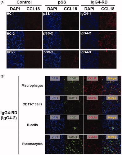 Figure 6. CCL18 protein expression and CCL18-expressing cells in LSGs of IgG4-RD. (A) Comparison of CCL18 protein expression in LSGs of patients with IgG4-related disease (IgG4-RD, n = 3), primary Sjögren’s syndrome (pSS, n = 3), and healthy controls (HC, n = 3). Representative fluorescence microscopic images of DAPI/CCL18 staining. Original magnification ×600. IgG4; IgG4-related disease, DAPI; 4',6-diamidino-2-phenylindole. (B) Fluorescence microscopic images of DAPI/cell surface markers/CCL18/merged of a representative patient (IgG4-2) with IgG4-related disease (IgG4-RD). Original magnification ×600. IgG4: IgG4-related disease; DAPI: 4',6-diamidino-2-phenylindole.