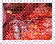 Figure 3. Venous resection with anatomical reconstruction during Whipple’s procedure.By courtesy of Professor Philippe Bachellier.