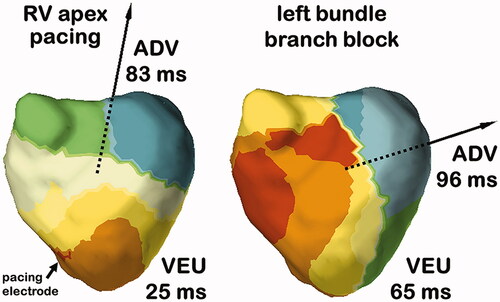 Figure 3. Typical ECGi activation maps during RV apex pacing (left panel) and left bundle branch block (right panel). While total activation time and QRS width were similar, RV apex pacing was associated with much lower VEU and more apex-to-base activation.
