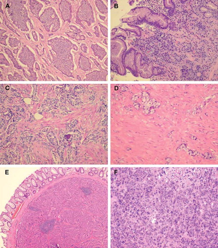 Figure 1. Different growth patterns for NETs. (A) Typical insular pattern of small intestinal NET. (B) ECLoma: discrete small islands of tumour cells in the gastric fundic mucosa. (C) “somatostatinoma” of the duodenum: glandular pattern with psammoma bodies. (D) Goblet cell carcinoid of the appendix. (E) Trabecular pattern in a rectal carcinoids. (F) PDEC (poorly differentiated endocrine carcinoma).