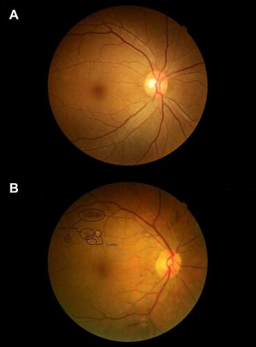 Figure 1 The fundus photos of non-DR and DR patients with T2DM.Notes: (A) The fundus photo reflects the normal fundus characteristics of patients with T2DM. (B) The fundus photo reflects the abnormal fundus characteristics of DR patients.