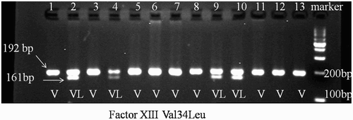 Figure 1.  Electrophoresis of digested PCR products. The presence of Leu mutation in FXIII gene provides a restriction site for Dde I enzyme, whereas, the amplified fragment remains un-cut (192 bp) in the presence of Val nucleotide variation. (Lane Marker, 100 bp DNA ladder; Lanes 1,3,5,6,7,11,12,13, V34V - G/G genotype - (192-bp PCR product); Lanes 2,4,9,10 V34L - G/T genotype - (192 and 161-bp).