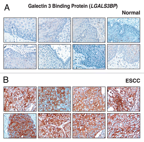 Figure 7 Validation of LGALS3BP using immunohistochemical labeling. Expression of LGALS3BP in representative normal esophageal squamous mucosa (A). Expression of LGALS3BP in ESCC is observed in both stromal and epithelial compartments (B).