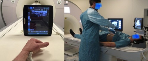 Figure 4 Ultrasound in a MRI imaging suite for MRI/US fusion.Notes: (A) A tablet US of a large diagnostic imaging vendor placed only 1 m away from the 3T MRI of another large imaging vendor. The US system is not approved and certified for use in the MRI suite, but direct applications under US guidance could give a new boost to performing interventional and therapeutic procedures in the MRI suite. (B) Cognitive fusion of MRI and US images on separate monitors.