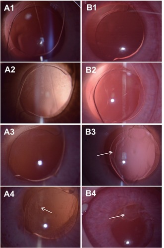 Figure 9 Slit lamp micrographs of IOL with (A) or without (B) (HEP/CTDNP)5 multilayer modification in rabbit eye. Images A1/B1 to A4/B4 are obtained at postoperative 1 day, 1 week, 2 weeks and 2 months postoperatively. The white arrows indicate the PCO.