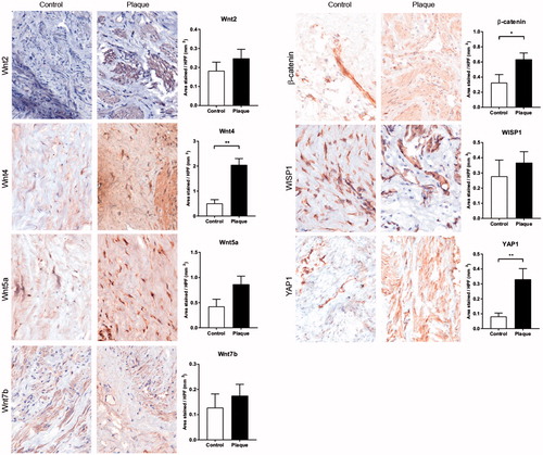 Figure 2. Representative pictures and quantification of immunohistochemical staining, both in tunica albuginea (control) and plaque. The following proteins were tested: Wnt2; Wnt4; Wnt5a; Wnt7b; β-catenin; WISP1; YAP1. *p < .05, **p < .01 as determined by the Wilcoxon paired rank test. HPF: high-power field.