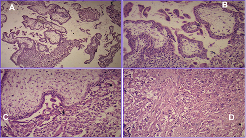 Figure 6 Mildly edematous chorionic villi of variable size and adjacent syncytiotrophoblastic giant cells as well as extravillous intermediate trophoblasts (A–C). Sheets of intermediate trophoblasts infiltrating the fallopian tube wall (D). (H&E, A, B, C and DΧ10).
