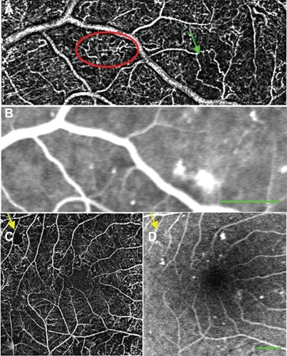 Figure 5 nCPM and FA images from patients with NPDR. (A) nCPM image of the left eye of a 59-year-old male with NPDR (nine series combined into one). (B) Corresponding FA scanning laser ophthalmoscopic image. The nCPM demonstrates vascular loops (red ellipse) and vascular shunts (green arrow). FA images are capable of showing these patterns,Citation22,Citation46 the FA presented here do not show these patterns due to late timing and suboptimal focusing in that area. (C) nCPM image of the left eye of a 60-year-old male with NPDR (eleven series combined into one). (D) Corresponding FA scanning laser ophthalmoscopic image; yellow arrows demonstrate nonperfusion. Most likely better FA images than those obtained here can be accomplished.
