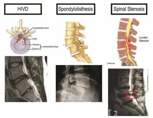 Figure 1. Three types of spinal disease with similar symptoms. An X-ray of each is shown.