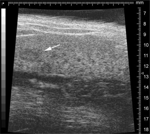 Figure 1 The representative image of ultrasound detected the tumor growth in liver.Notes: Arrow indicates the tumor; length, 2.2 mm; width, 1.5 mm.