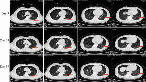 Figure 8. Chest CT scans on days 5, 14 and 19 after onset for Pt-6. CT showed scattered bilateral multiple high-density effusions, faintly exudative shadows along the lungs especially in the left lung on day 10. Effusions were gradually absorbed over time. Red arrows indicate typical lesions.
