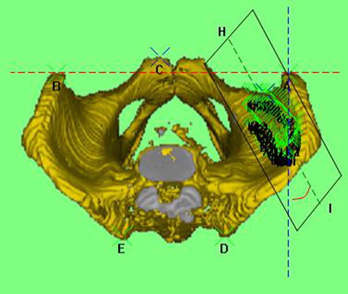 Figure 5. Cephalocaudal view showing the relationship between the plane of the acetabulum and plane TPPAx; line HI is formed by the intersection of the two planes, and the angle between this line and plane TPPSag is the anteversion relative to the TPP coordinate system (AVTPP). [Color version available online.]