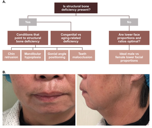 Figure 6 (A) Decision tree illustrating considerations for clinical evaluation of structural bone deficiency in the lower face of patients; (B) case example of a female patient 53 years of age with structural bone deficiency in the lower face. Photos courtesy of D. Li, MD.