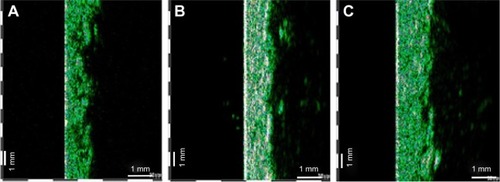 Figure 3 Ultrasonographic aspect of SD before (A), after 3 weeks (B) and after 6 weeks (C) of cream application- 22 MHz transducer, B-scan. Abbreviation: SD, striae distensae.