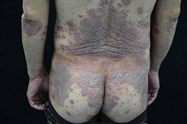 Figure 1 Large dark red patches can be seen on the back of the buttocks, with a large number of silver-white scales attached to them, most of which are fused into pieces, which are map-shaped and annular, and local skin lesions show lichen-like changes.