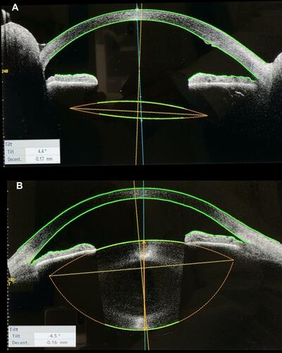 Figure 6 Clinical records of a representative patient at six months after surgery (case eight) Anterior segment OCT images. Comparison in the same patient between the sutureless intrascleral fixated IOL “Catcher Pole” technique left eye (A) and the natural crystalline lens right eye (B), note the same tilting, decentration and the correct IOL centration and positioning.