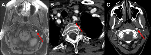 Figure 4 (A) Intramural hematoma in the vessel wall of the left cervical internal carotid artery (ICA) (hyperintense signal on T1w). (B) The dissection with false lumen in the origin of the left vertebral artery. Of note, no dissection in the subclavian or aorta is noted. (C) Dissection flap and double lumen sign of the left cervical ICA. Pathologies are highlighted with red arrows.