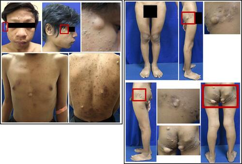 Figure 1 An unusual and rare clinical manifestation of EC. Generalized multiple ECs on the right temple, chest, and back with a giant EC on the left gluteal region presenting as skin-colored nodules.