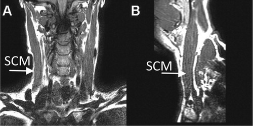 Figure 1. SCM in coronal (A) and sagittal (B) planes.