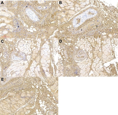 Figure 7 Immunohistochemical analysis of the expression of (A) BMP-2 (*membrane-lining cells, †spindle cells), (B) TGF-β (*membrane-lining cells, †spindle cells), (C) vWF, (D) VEGF, and (E) IL-6.