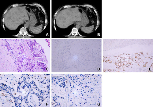Figure 1 Radiographical findings and pathological reports for case 1. CT scan of the abdomen revealed multiple low-density lesions in the liver accompanied by liver cysts (A and B). Pathological report revealed a diagnosis of SCC (C). IHC analysis showed that CK7 staining (D) was negative but p63 expression (E) was positive. Ventana IHC analysis (Clone NO. SP263) indicated that PD-L1 expression on tumor cells and tumor-associated immune cells was negative (F and G).