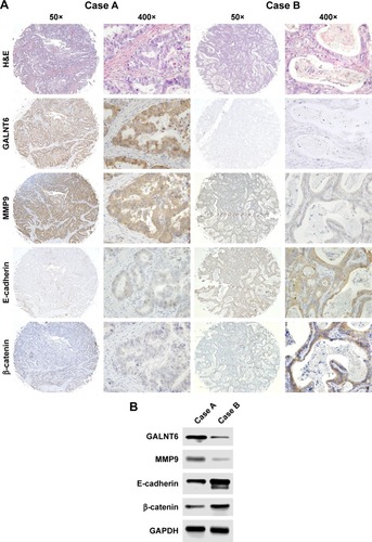 Figure 4 Expression of GALNT6 and related proteins in GC tissues in the validation study.