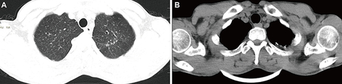 Figure 1 Chest computed tomography (CT) scans of the patient on July 4, 2017. (A) scattered large nodular shadows in the upper lobes of both lungs; (B) thickening and calcification of the left pleural apex.