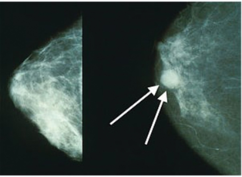 Figure 1. (Left side) Normal breast and (Right side) cancerous breast.