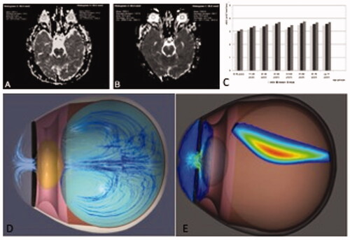 Figure 4. (A) MRI scan of Infant Eye for measuring the diffusivity i.e. ADC. (B) MRI scan of aged eye for measuring the diffusivity. (C) Graph depicting the increasing in the molecular diffusivity of vitreous humour with aging. Used with permission of American Society of Neuroradiology from diffusion changes in the vitreous humor of the eye during aging, İ Meral and Y. Bilgil, 32(8) 2011; permission conveyed through Copyright Clearance Center, Inc. (D) Simulation of the aqueous humor flow in anterior and posterior segment of eye. (E) Simulation of the distribution of Anti-VEGF drug in eye following Intravitreal injection. Reproduced from 1. Dörsam S, Olkhovskiy V, Friedmann E. Modeling and Simulation of the Aqueous Humor Flow in the Human Eye. PAMM (2019) 19:e201900462. Licensed under CC BY 4.0.