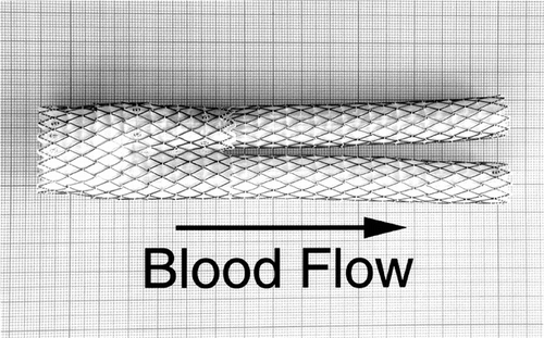 Figure 1 An unimplanted AneuRx device fully deployed and manufactured by Medtronic AVE: it consists of a bifurcation with limbs of different lengths, one long and one short, in which an ipsilateral limb is inserted. The thin wall of the polyester is externally supported by self-expanding stents made of shape memory alloy (Nitinol) and sewn by means of multifilament polyester sutures.