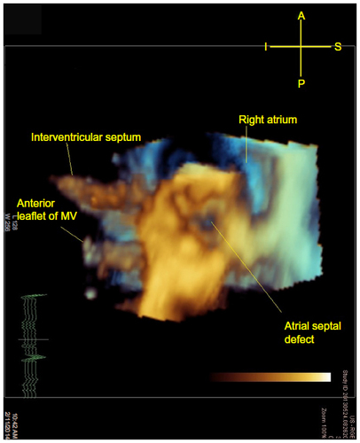 Figure 2 A 3D image cropped from a full-volume dataset of a secundum ASD as viewed from the left atrium.
