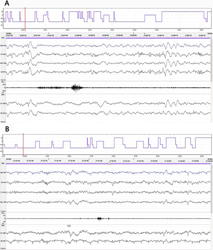 Figure 2 Representative sleep architecture during the period of study-drug infusion and polysomnographic traces at the time point indicated by the cursor (red line) of patients in the control (A) and dexmedetomidine (B) groups. Severe sleep fragmentation and sleep architecture disorganization were seen in both patients. Compared with the patient in the control group (A), patients in dexmedetomidine (B) showed decreased sleep stage N1, total arousal index and arousal index of NREM sleep, increased N2 and N3 sleep. N1= stage N1 sleep; N2= stage N2 sleep; N3= stage N3 sleep; R= stage REM sleep; W=wakefulness.