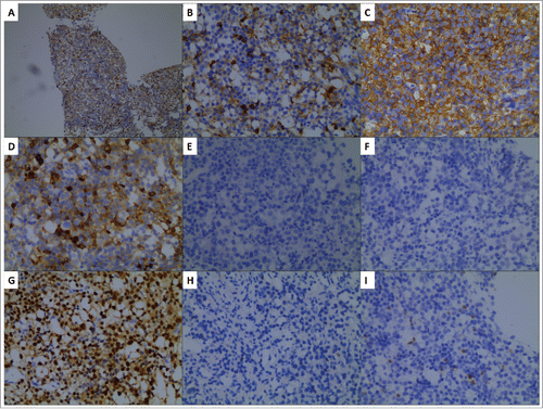 Figure 1. Immunohistochemical staining (IHC) of DLBCL tissue sample. IHC staining of CD5 (A). (Original magnification, *100). Positive IHC staining of CD5 (B), CD20 (C), CD79a (D), MUM1 (G), and negative staining of CD10 (E), Bcl-6 (F), MYC (H), CD3 (I). (Original magnification, *400).