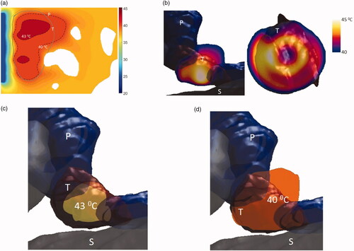 Figure 11. Simulated temperature distributions of endoluminal ultrasound hyperthermia directed at a pancreatic tumor (case II medium body) using applicator geometry II (two 1 cm OD × 0.7 cm long transducers, 3.4 MHz, 4.6 cm balloon aperture): (a) temperature distribution with highlighted 40 and 43 °C contours across a central axial plane, with both tumor (T) and pancreas (P) delineated; (b) Temperature distribution across a central axial plane and a transverse plane at a depth of 11 mm from aperture surface overlaid with model anatomy; (c) 43 °C iso-temperature volume inside the target; and (d) 40 °C iso-temperature volume inside the target. P: pancreas, S: stomach, T: tumor.