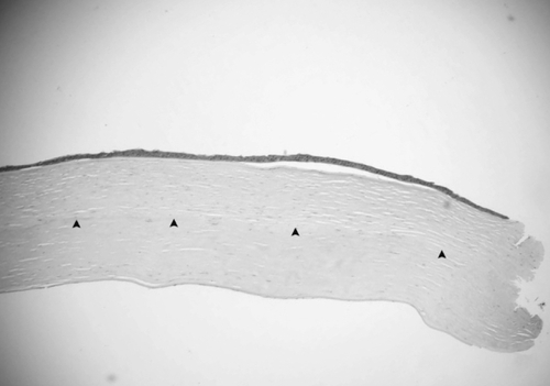 Figure 1 Light photomicrographs of histological section obtained from the periphery of the corneal button (hematoxylin and eosin stain). Photomicrograph showing detached epithelial layer and attenuated endothelial layer. Arrows indicate the interfaced between the host and donor stroma. Original magnification × 40.