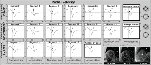Figure 2 Radial velocity graphs for individual left ventricular segments (American Heart Association segmentation model) during a cardiac cycle, showing the influence of reflected aortic pressure waves on radial motion in early diastole. The graphs represent average myocardial velocities for all volunteers. Positive values show inward motion toward the center of the ventricle, while negative values show outward expansion. Average velocities for basal, mid, and apical slices are shown in bold outline. The arrows (a) point toward an upward directed notch in early diastole, synonymous with the notch seen on the aortic pulse wave (Figure 1). The right lower images show left ventricular short axis images of the base, mid ventricle and apex, divided into 16 segments, which corresponds to the individual left ventricular segments.