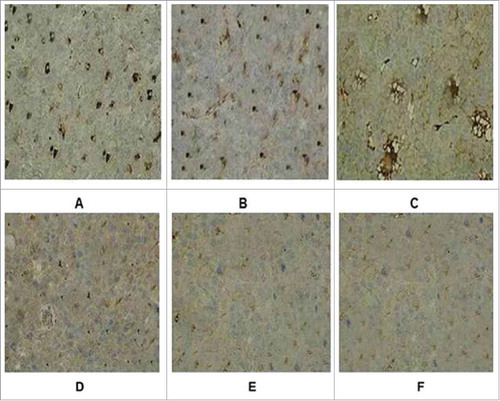 Figure 5. Immunohistochemical staining of tumor tissue in groups. (A) Recombinant adenovirus 5 group. (B)(Adenovirus 5+ LMP2A) group. (C) (Adenovirus 5+ hGM-CSF) group. (D) (Adenovirus 5+ plasmid) group. (E) Adenovirus 5. (F) PBS. The tumor cells in the recombinant adenovirus 5 group compared with the control group, the CD4 cells were more, and in a large number of CD4 in tumor tissue; Adenovirus 5(LMP2A) and Adenovirus 5 (hGM-CSF) group can also be seen with a certain extent part of tumor tissue necrosis and some of CD4 cells, but CD4 cells were less than recombinant adenovirus 5 group, there is no significant difference in the staining results on adenovirus 5 and (adenovirus 5+ plasmid) group. PBS had no tumor necrosis and CD4 cells.