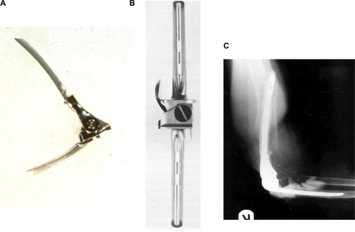 Figure 1 (A) Fully constrained uniaxial TER (Dee elbow): late 1960s. (B) Fully constrained uniaxial TKR (Walldius knee): same period. (C) Loosening of the components of a uniaxial TER (Stanmore elbow). Note the considerable bone loss around the humeral stem and perforation of the cortex, which would complicate a revision procedure.